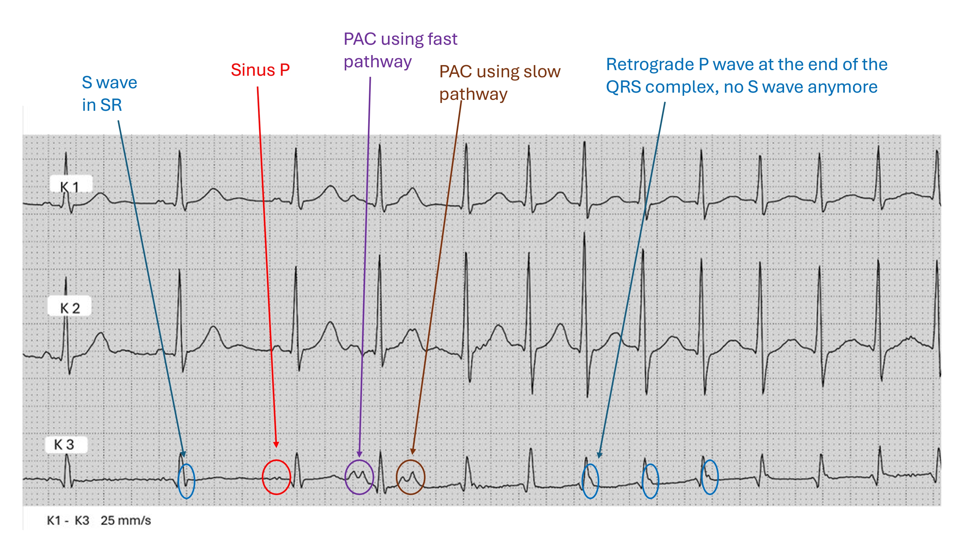 AVNRT ECG Guru Instructor Resources